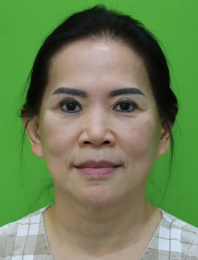 Revision Facelift 3 Months Later, Including Removal of the Existing Scar image 4