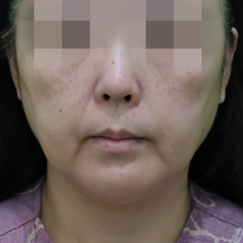 Early Swelling Changes After Facelift (Day 3, 1 Week, 2 Weeks) image 24
