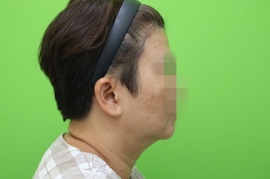 이중턱살, 설마 아직도 지방인줄 알고 계셨나요? 관련 이미지 7
