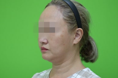 이중턱살제거, 마른 몸에 이중턱만 고민이라면? 관련 이미지 2