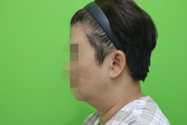 이중턱살, 설마 아직도 지방인줄 알고 계셨나요? 관련 이미지 9