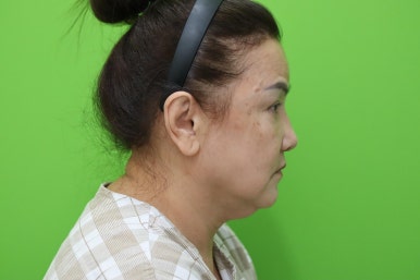 Facelift Review: A Woman in Her Early 60s Looks More Than 10 Years Younger image 4