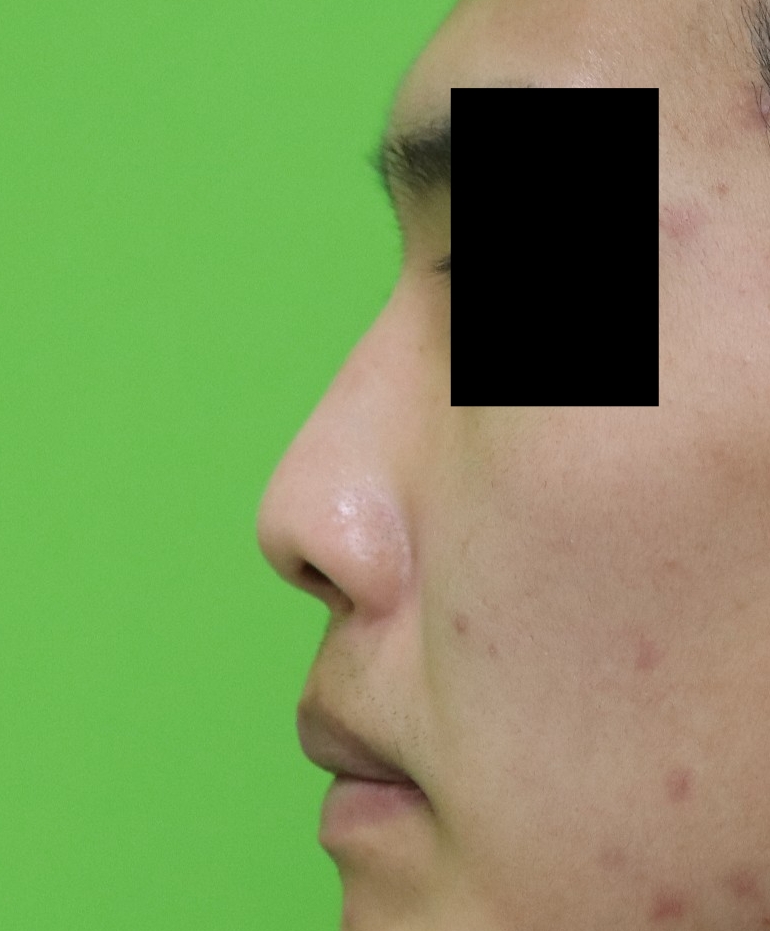 Crooked Nose Surgery: If You Don’t Know This, You’ll Need Revision Surgery Again. image 5