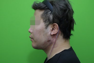 Double Chin Muscle Tying Swelling, Day 1 Appearance image 10