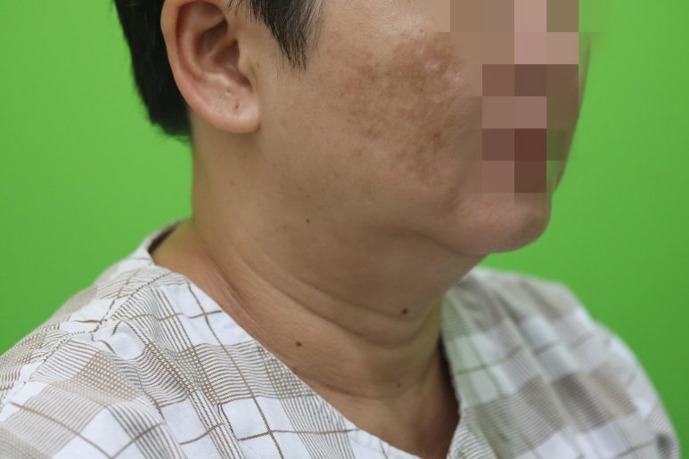 이중턱살, 설마 아직도 지방인줄 알고 계셨나요? 관련 이미지 4