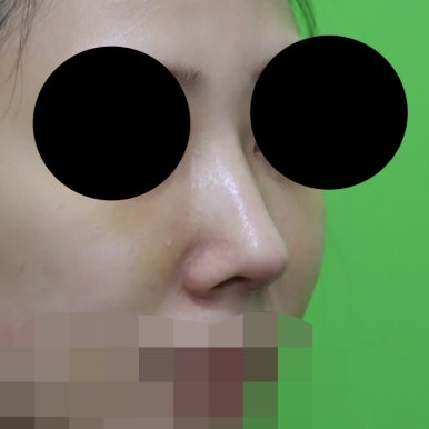 매부리코교정, 코뼈 제거 없이 재배치로 해결 관련 이미지 3
