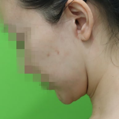 몸은 말랐는데 이중턱살제거가 시급할 때? 관련 이미지 24