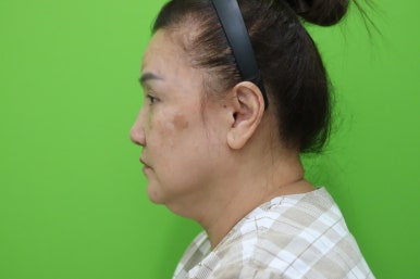 Facelift Review: A Woman in Her Early 60s Looks More Than 10 Years Younger image 2