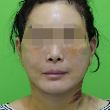 안면거상술, 이중턱 근육 묶기 후 회복 기간 관련 이미지 5
