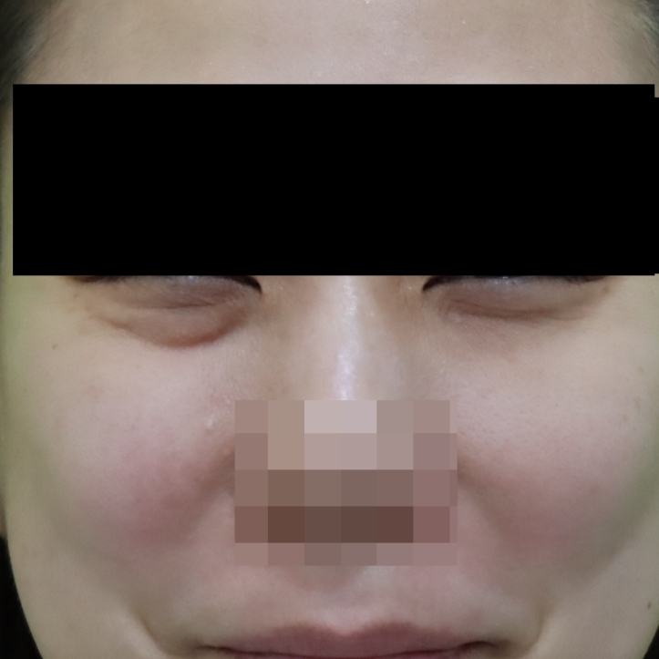 웃을때 눈밑지방, 정말 근육이라 개선이 안될까? 관련 이미지 2