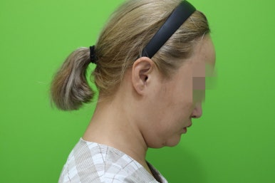 이중턱살제거, 마른 몸에 이중턱만 고민이라면? 관련 이미지 17