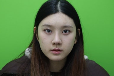 복코성형, 연예인 지망생의 리얼 후기 관련 이미지 11