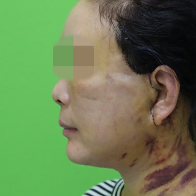 안면거상술, 이중턱 근육 묶기 후 회복 기간 관련 이미지 7
