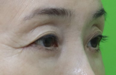 하안검수술흉터, 이 원본 사진에서 잘 보이나요? 관련 이미지 15