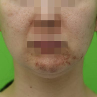 몸은 말랐는데 이중턱살제거가 시급할 때? 관련 이미지 11