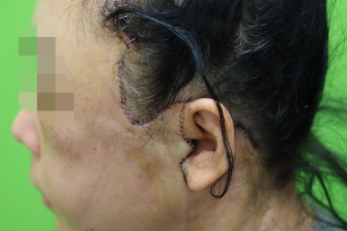 Early Swelling Changes After Facelift (Day 3, 1 Week, 2 Weeks) image 11