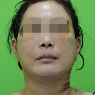 안면거상술, 이중턱 근육 묶기 후 회복 기간 관련 이미지 6