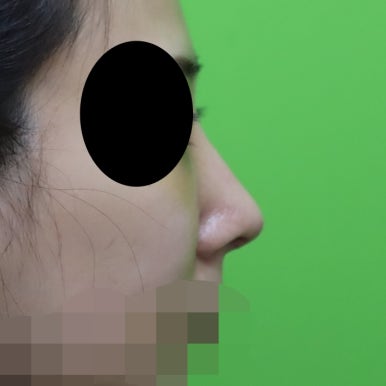 매부리코교정, 코뼈 제거 없이 재배치로 해결 관련 이미지 4