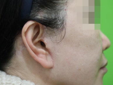 안면거상 재수술, 왜 3년전 수술이 효과가 없었을까? 관련 이미지 29