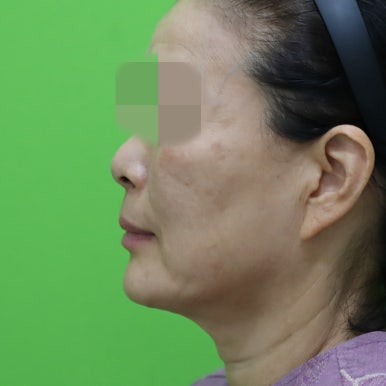 안면거상술, 이중턱 근육 묶기 후 회복 기간 관련 이미지 23