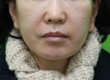 안면거상 재수술, 왜 3년전 수술이 효과가 없었을까? 관련 이미지 15