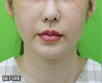 Facelift Results: Can They Be Good Even at a Young Age? image 1