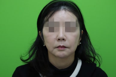 50대 여성 안면거상술 및 이중턱 근육묶기 후기 관련 이미지 6