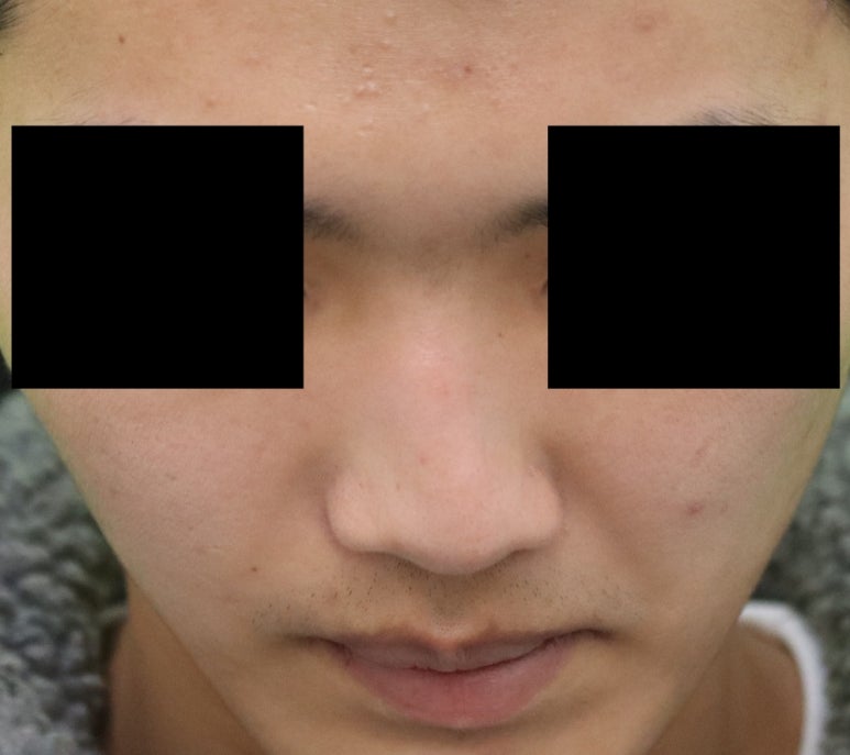 Crooked Nose Surgery: If You Don’t Know This, You’ll Need Revision Surgery Again. image 3