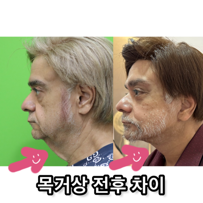 Facelift Review: Why the Neck Lift Technique Matters image 19