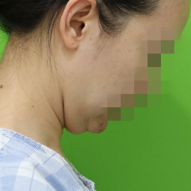 몸은 말랐는데 이중턱살제거가 시급할 때? 관련 이미지 3