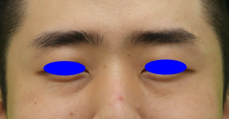 3 Things You Must Know Before Male Under-Eye Fat Repositioning image 3