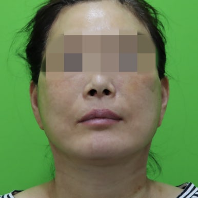 안면거상술, 이중턱 근육 묶기 후 회복 기간 관련 이미지 12