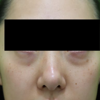 눈밑지, 지방이식 같이 하면 회복이 더 오래 걸리나? 관련 이미지 3
