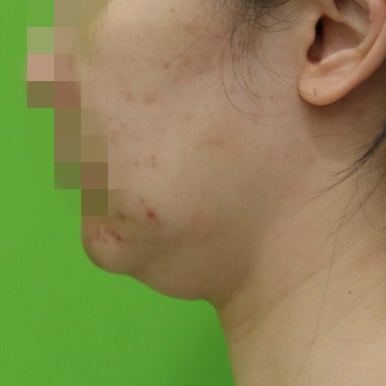 몸은 말랐는데 이중턱살제거가 시급할 때? 관련 이미지 4