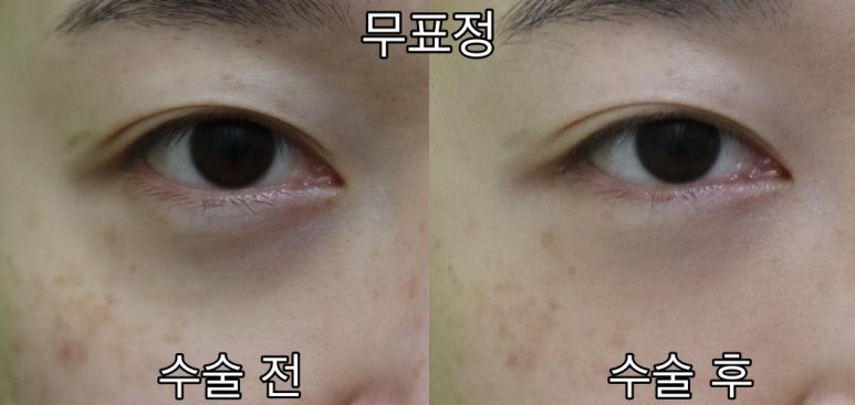 눈밑패임, 이거 모르면 효과 없는 시술에만 돈 씁니다. 관련 이미지 5