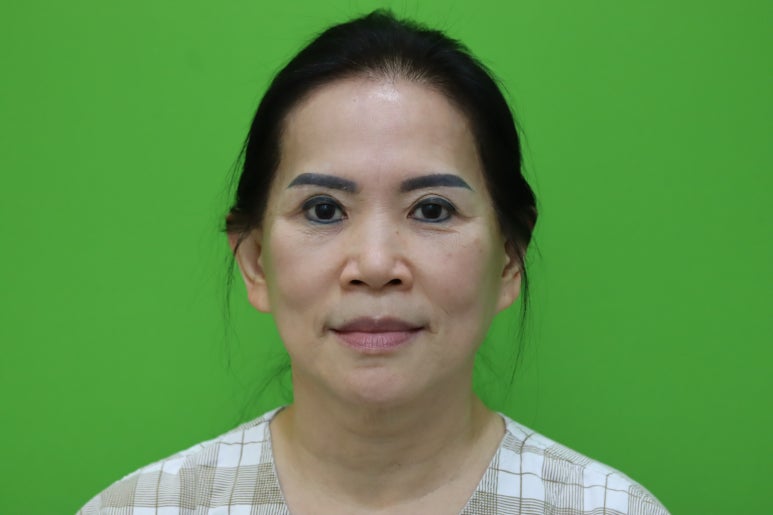 Revision Facelift 3 Months Later, Including Removal of the Existing Scar image 1