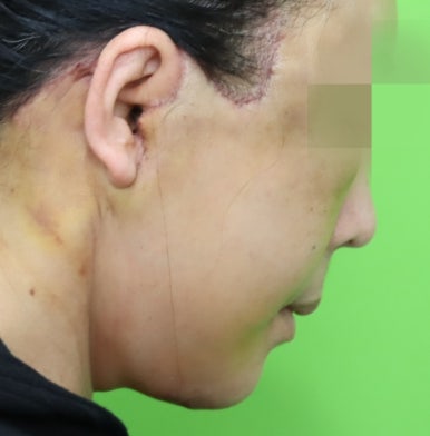 Early Swelling Changes After Facelift (Day 3, 1 Week, 2 Weeks) image 20