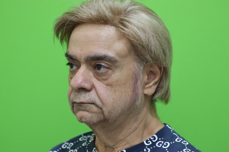 Facelift Review: Why the Neck Lift Technique Matters image 4