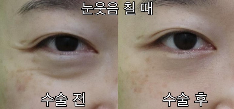 눈밑패임, 이거 모르면 효과 없는 시술에만 돈 씁니다. 관련 이미지 6