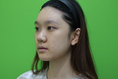 복코성형, 연예인 지망생의 리얼 후기 관련 이미지 8