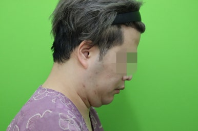 Double Chin Muscle Tying Swelling, Day 1 Appearance image 17