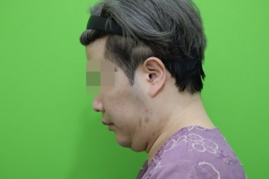 Double Chin Muscle Tying Swelling, Day 1 Appearance image 4