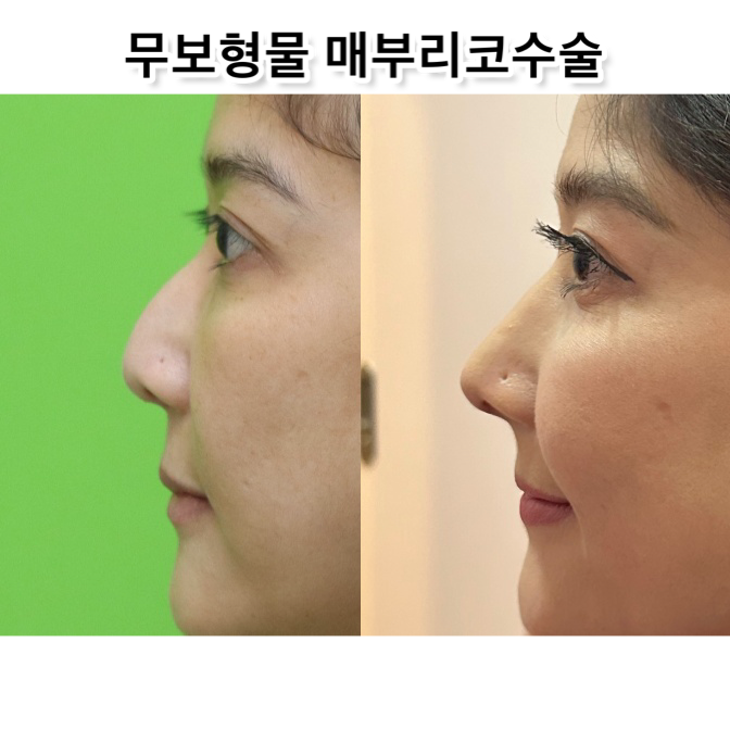 매부리코성형비용, 상담실장이 보면 싫어할 양심 선언 관련 이미지 12