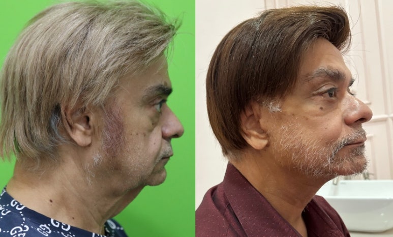 Facelift Review: Why the Neck Lift Technique Matters image 17