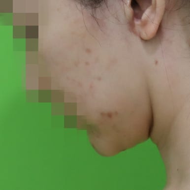 몸은 말랐는데 이중턱살제거가 시급할 때? 관련 이미지 10