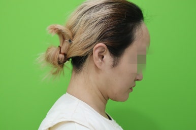 이중턱살제거, 마른 몸에 이중턱만 고민이라면? 관련 이미지 18