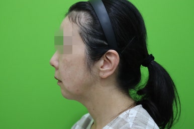 50대 여성 안면거상술 및 이중턱 근육묶기 후기 관련 이미지 3