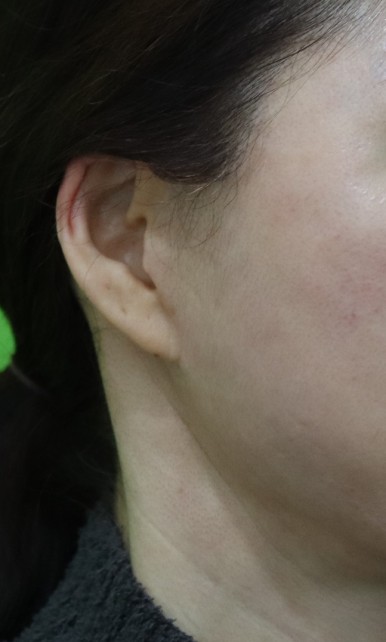 Facelift Scars, the Reason They Look Seamless After 6 Months image 17