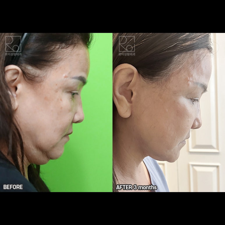 Facelift Review: A Woman in Her Early 60s Looks More Than 10 Years Younger image 11