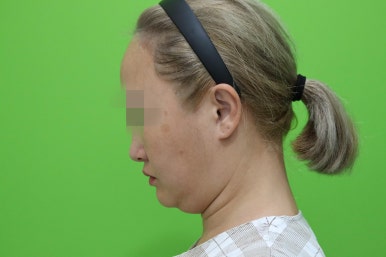 이중턱살제거, 마른 몸에 이중턱만 고민이라면? 관련 이미지 4